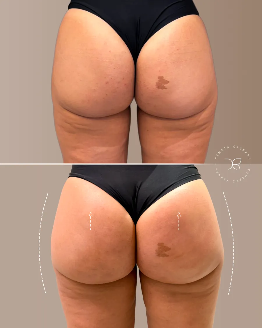 Antes e depois 2